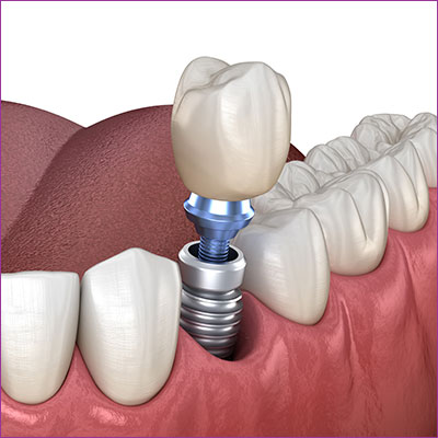 Michelzahn Implantate